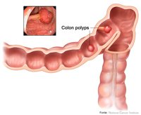 Câncer colo-retal: prevenção, diagnóstico e tratamento